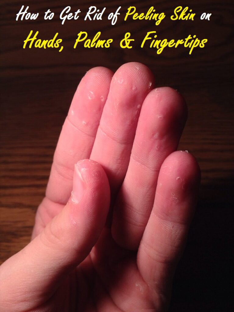 How to Get Rid of Peeling Skin on Hands, Palms and Finger Tips Enjoy